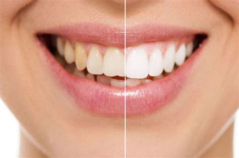 3 Options For Whitening Your Teeth Imperial Dental Associates