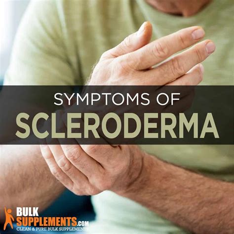 Scleroderma Symptoms Causes And Treatment