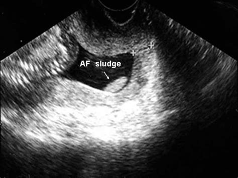 Whats Considered A Large Subchorionic Hematoma Peter Brown Bruidstaart