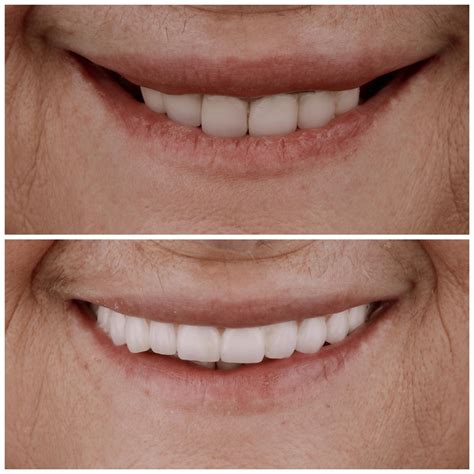 Antes y después de prótesis completa fija sobre implantes dentales