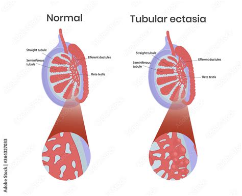 Tubular Ectasia Of Rete Testis With Normal Testicular Anatomy Stock Vector Adobe Stock