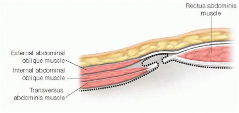 Umbilical Epigastric Spigelian And Lumbar Hernias Basicmedical Key