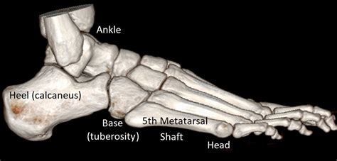 5th Metatarsal Fracture Dr Ben Beamond Adelaide