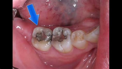 Painful Broken Decayed Tooth The Cerec Crown Solution Youtube