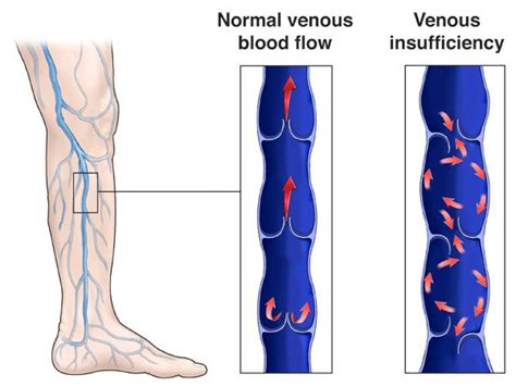 Common Signs And Symptoms Of Venous Disease