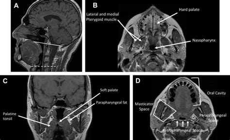 Pitfalls In The Staging Of Cancer Of The Oropharyngeal Squamous Cell