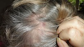 raised bumps on scalp - pictures, photos