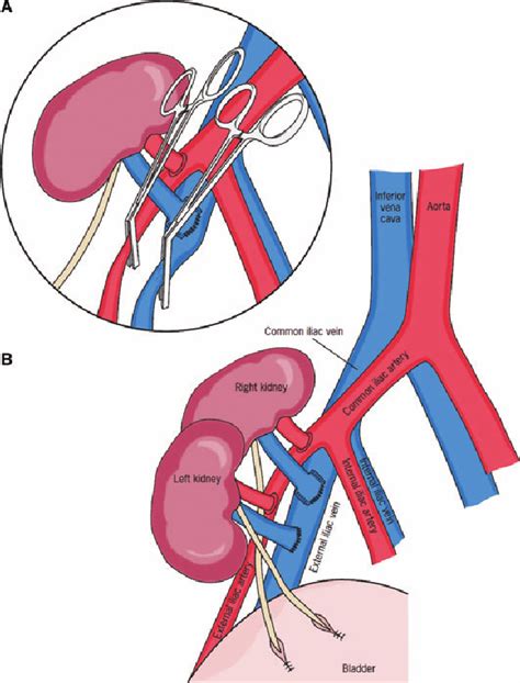 Surgical Technique Of Unilaterally Positioned Dual Kidney Download