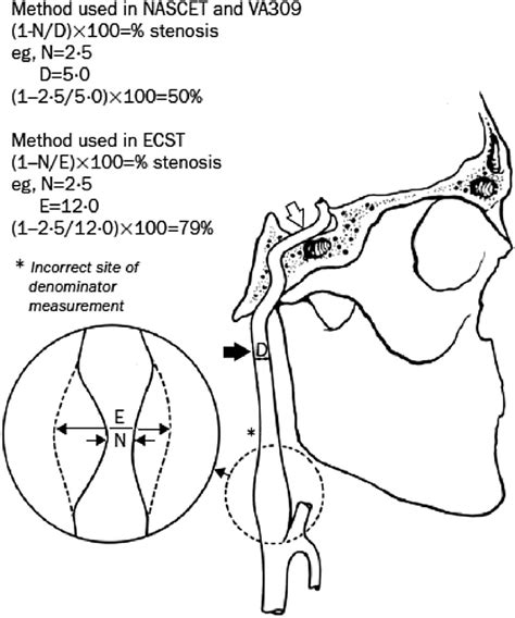 ECST And NASCET Methods For Measuring Stenosis Severity Reproduced