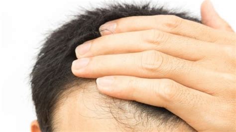 Shaving Head Gave Me Control Says Ni Alopecia Sufferer Bbc News