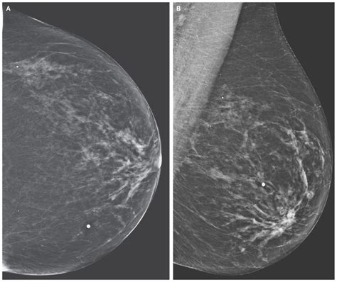 Case 29 2016 — A 53 Year Old Woman With Pain And A Mass In The Breast