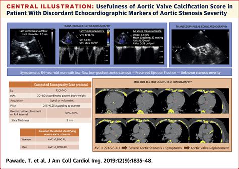Why And How To Measure Aortic Valve Calcification In Patients With