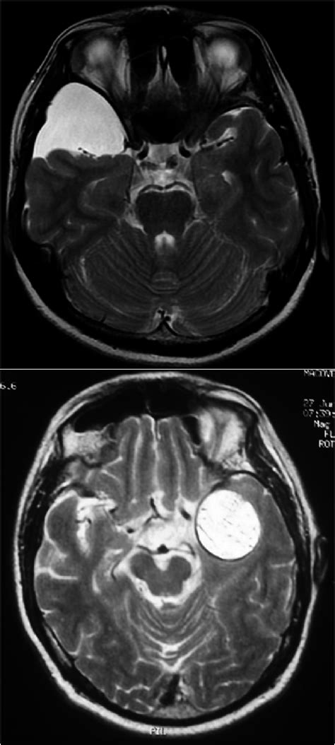 Differential Diagnosis Between An Arachnoid Cyst A And An Epidermoid Download Scientific