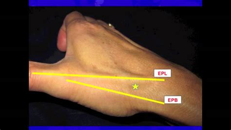 Thumb Carpal Metacarpal Cmc Joint Injection Youtube