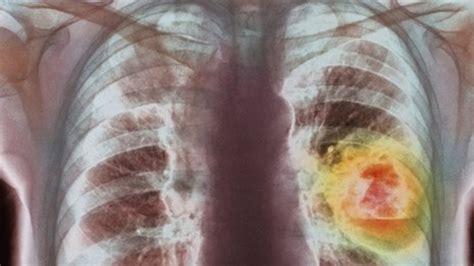 Persistent Cough Could Be Lung Cancer Warning Bbc News