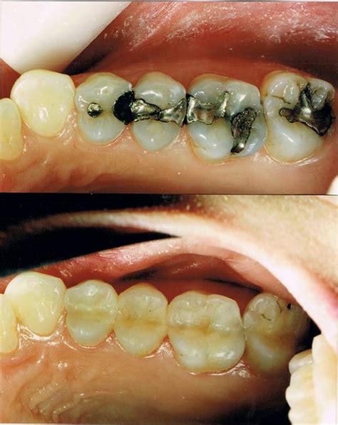 Amalgam first used by chinese •907 ad: Amalgam Removal | Amalgam Fillings | Holistic Dentist