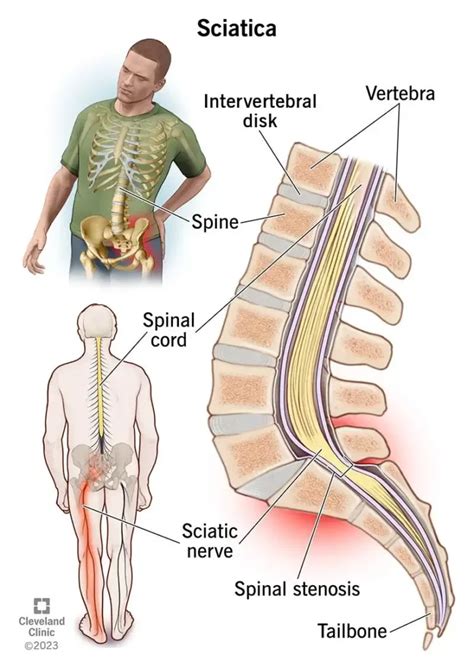 Running With Sciatica Expert Tips For Relieving Pain Pace Passion