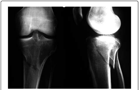 Moore Type 1 Tibial Plateau Fracture Secondary To Alpine Ski Injury