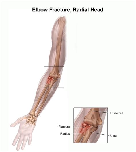 Radial Head Fractures Hand2shoulder Clinic