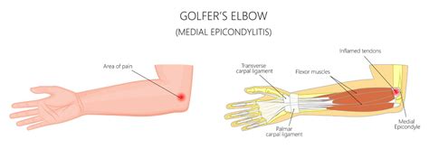 Medial Epicondylitis Golfers Elbow Lump Medial Epicondylitis Sport