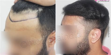How To Know If You Are An Ideal Candidate For Hair Transplantation