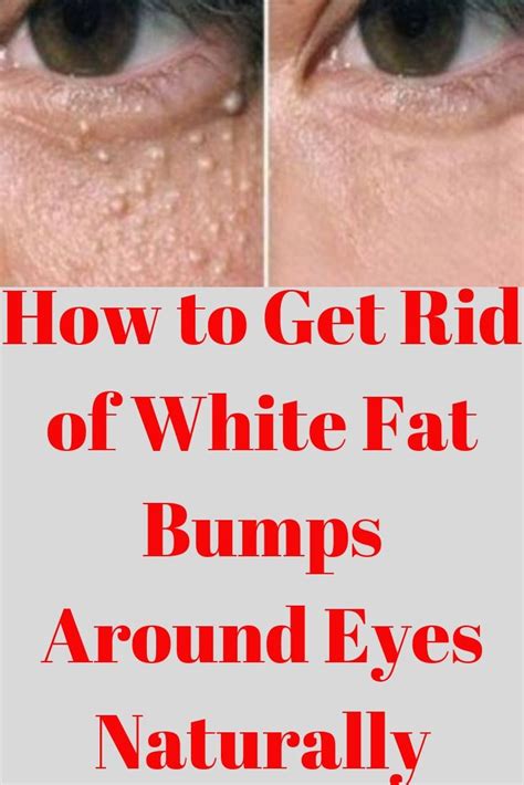 How To Get Rid Of White Fat Bumps Around Eyes Naturally Yoga4daily