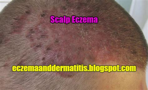 Scalp Eczema Eczema And Dermatitis