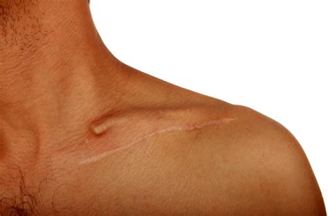 Lump On Collarbone Symptoms Causes And Treatment