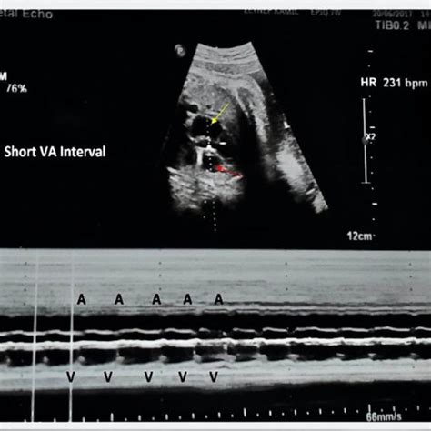 M Mode Echocardiogram Of The Heart In A Nonhydropic Fetus At 35 Weeks