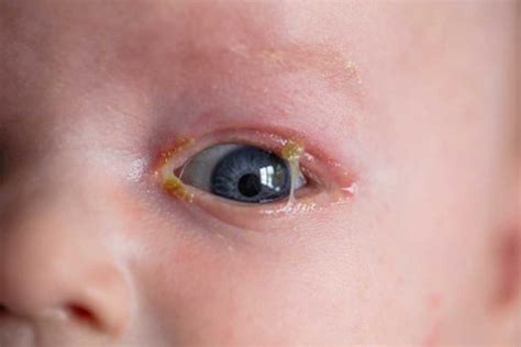 Sticky Eyes In New Born Babies Symptoms Reason And Treatment