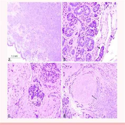 A An Image Of The Polymorphous Low Grade Adenocarcinoma Comprising