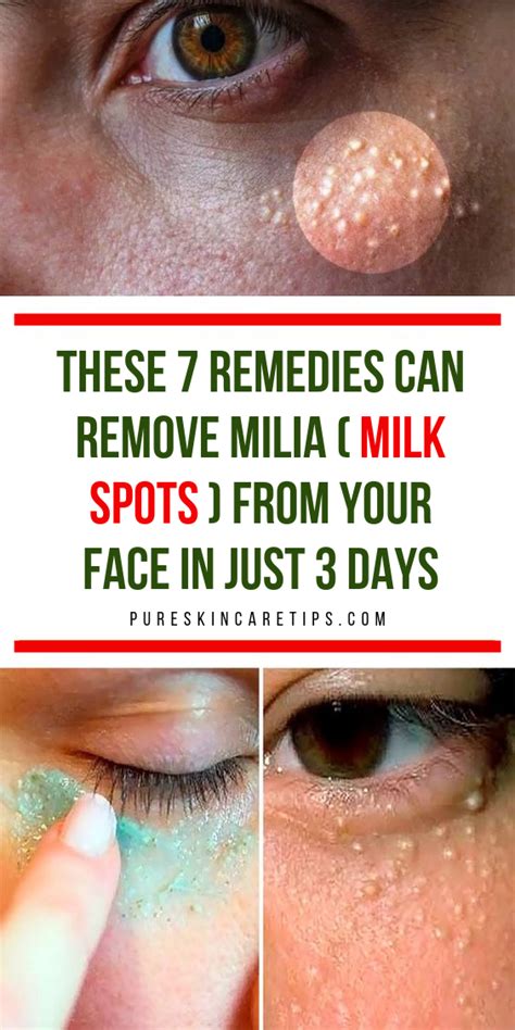 Home Remedies For Milia A Comprehensive Guide Martlabpro