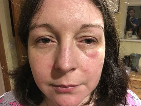Swelling Eye Punch In The Face Swollen Eyes Hashimotos Disease