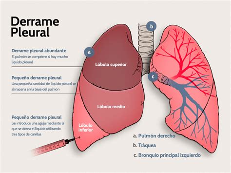 Derrame Pleural Definici N Causas S Ntomas Diagn Stico Y My Xxx Hot Girl