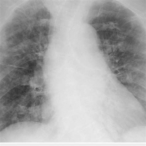 Initial Chest Radiograph Showing Bilateral Pulmonary Infiltrates