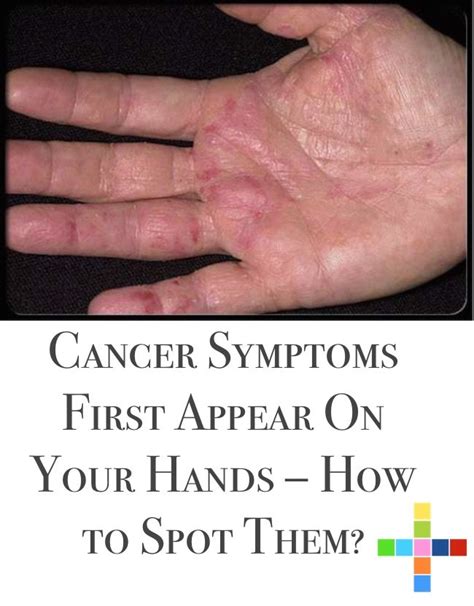 Cancer Symptoms First Appear On Your Hands How To Spot Them Positivemed