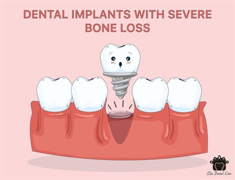 Dental Implants With Bone Loss Elite Dental Care