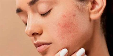 Have Acne Prone Skin Here Are Some Things You Should Avoid Doing Have