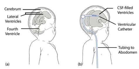 Hydrocephalus Shunt Placement