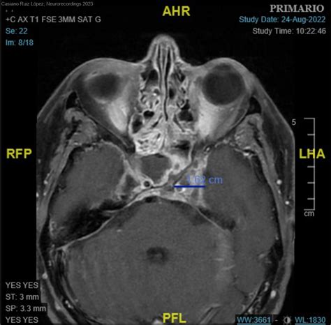 Tromboflebitis Septica Del Seno Cavernoso Izquierdo Como Manifestación Clínica De Una Sinusitis