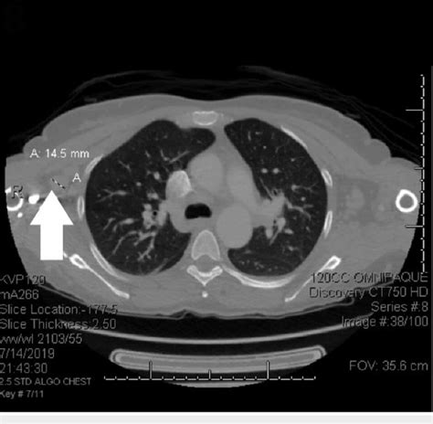 Ct Scans Before Treatment Scattered Nodular Lung Opacities Hilar