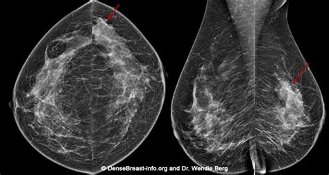 2d3d Mammography Density Assessment Software Densebreast Info Inc