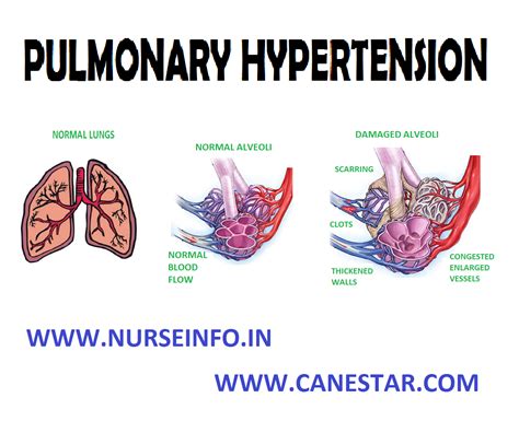 Pulmonary Hypertension Diagram