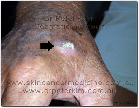 Early Skin Cancer Pictures