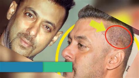 9 Bollywood Stars Who Went For Hair Transplant Surgery Youtube