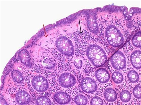 Microscopic Colitis A Hidden Cause Of Diarrhoea Hobson Healthcare