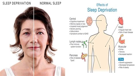 10 scary side effects of sleep deprivation youtube