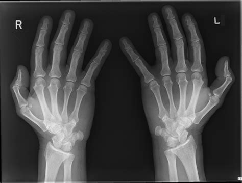 The patient sits or stands with the back facing the table and palmar surface of hand is placed in contact with the cassette placed at the table margin. Normal hand | Image | Radiopaedia.org