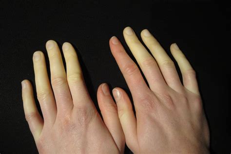 What Do You Know About Raynauds Disease