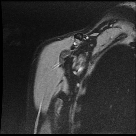 Avascular Necrosis Of Humerus Radiopaedia 58924 66174 H Nc Commons